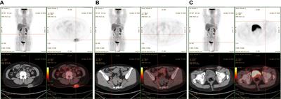 Case report: Case report and literature review: Treatment of sweat gland carcinoma